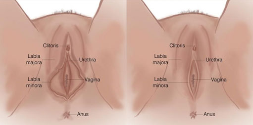 Result-Labiaplasty-Tunisia